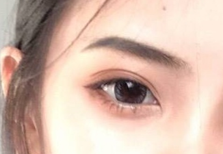 開眼角手術(shù)怎么樣？