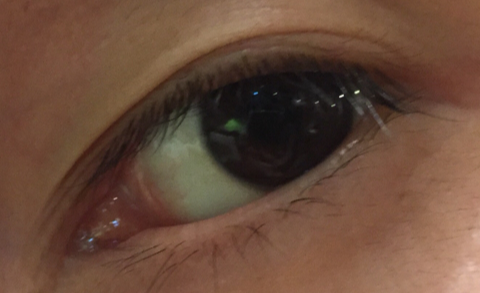 開(kāi)眼角需要熱敷幾天？