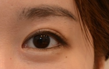 外眼角開大了能修復(fù)嗎？