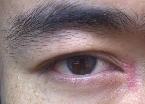 開眼角術后如何快速消腫？