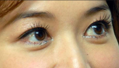 開眼角手術(shù)的優(yōu)點(diǎn)有哪些？開眼角手術(shù)有哪些安全性？