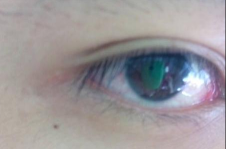 開眼角手術(shù)完全恢復(fù)需要多長(zhǎng)時(shí)間？