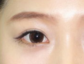 做完開(kāi)眼角效果好嗎？開(kāi)眼角術(shù)后注意事項(xiàng)有哪些？