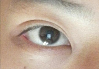 開眼角手術(shù)后會影響視力嗎？