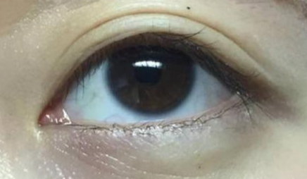 開眼角手術(shù)多長時間恢復？