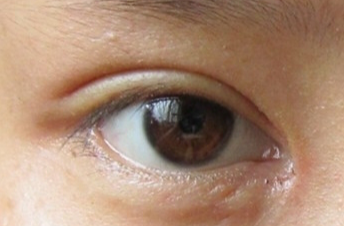 開(kāi)眼角手術(shù)會(huì)不會(huì)留疤？開(kāi)眼角手術(shù)后應(yīng)該注意什么？