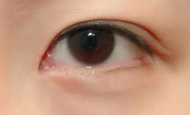 做完開眼角手術(shù)有什么優(yōu)勢？