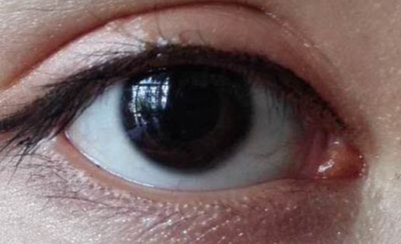 做開眼角疼不疼？做開眼角要多少錢？