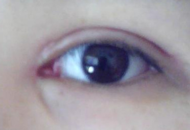 做完雙眼皮開內(nèi)眼角有風(fēng)險(xiǎn)嗎？做完開眼角怎樣護(hù)理？