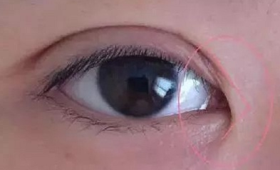 開眼角手術(shù)價(jià)格要多少錢？