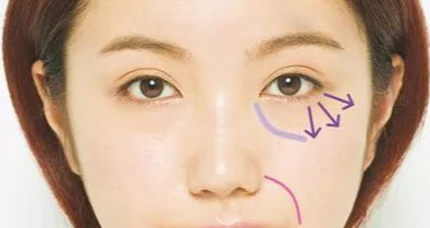 開眼角手術(shù)有沒有副作用？