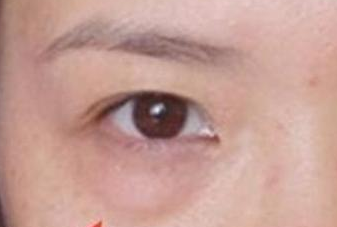 光纖溶脂去眼袋手術(shù)有哪些優(yōu)勢？