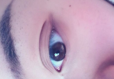 不開(kāi)刀祛眼袋效果怎么樣？玻尿酸祛眼袋多少錢(qián)呢？