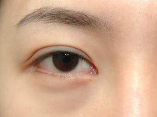 光纖溶脂去眼袋要多久能消腫？