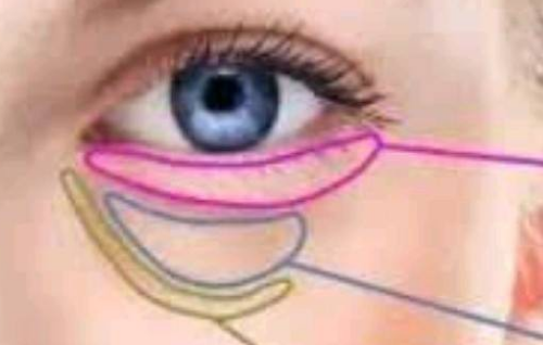 眶隔脂肪釋放去眼袋效果怎么樣呢？優(yōu)點有哪些？