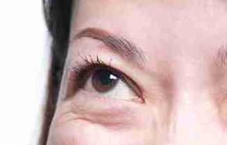 光纖溶脂祛眼袋好不好？