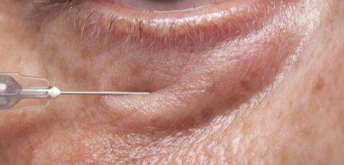 眼袋脂肪釋放的優(yōu)點(diǎn)有哪些？