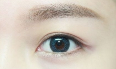開眼角需要注意的事項有哪些？