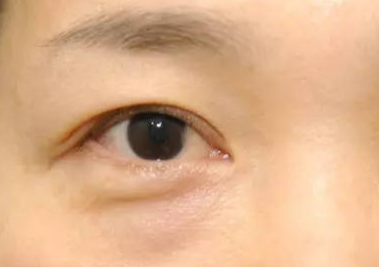 什么是埋線去眼袋？