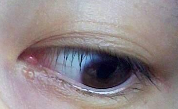 不開刀去眼袋多少錢？