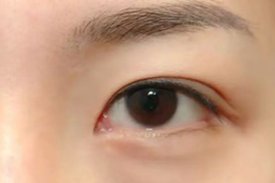 光纖溶脂祛眼袋有效果嗎？