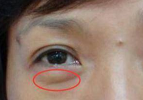 埋線去眼袋能維持多久？