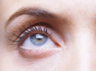 埋線去眼袋什么時候做好？埋線去眼袋有效嗎？