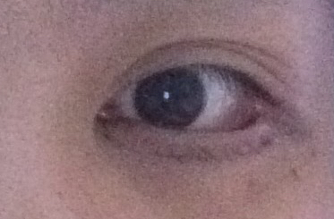 埋線去眼袋有效嗎？