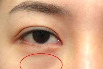 光纖溶脂祛眼袋需要多少錢？光纖溶脂怎么樣呢？