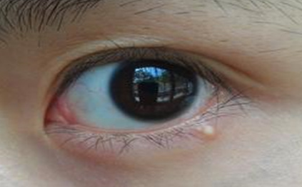 不開刀去眼袋安全嗎？