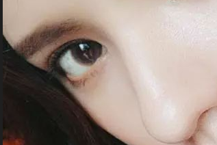 開眼角發(fā)紅怎么辦？