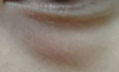 激光去眼袋和內(nèi)切哪個(gè)好？