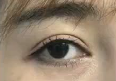 激光祛眼袋適應癥？