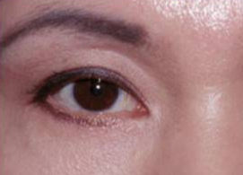 激光可以去眼袋嗎？祛除眼袋是用激光好還是手術(shù)好？