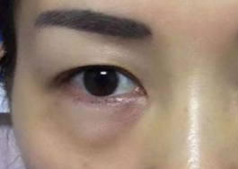 激光可以祛眼袋嗎？激光祛眼袋有哪些副作用？