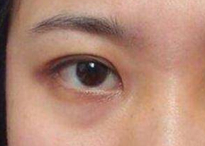 去眼袋是激光好還是內(nèi)切好？激光祛眼袋是什么原理？