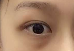 激光祛眼袋要多少錢？