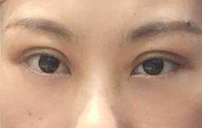 激光祛除眼袋的手術(shù)效果好嗎？