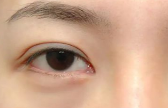 激光去眼袋多久做一次？