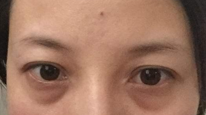 激光祛除眼袋有效嗎？