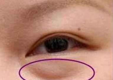 激光祛眼袋有什么好處？