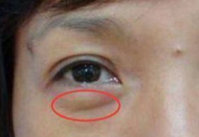 激光去眼袋可以管多久？激光祛眼袋多久可以恢復(fù)？