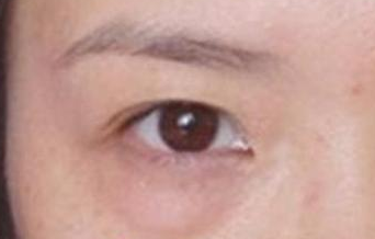 激光去除眼袋后遺癥有哪些？