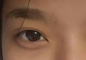 激光去眼袋后需多久能恢復(fù)？激光去眼袋快速有效嗎？