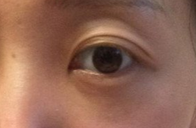 激光去眼袋要注意什么？