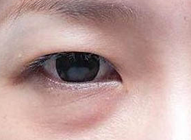 激光祛眼袋的方法效果好嗎？