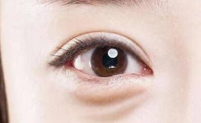 激光去眼袋有害處嗎？