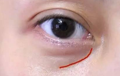 激光去眼袋手術(shù)費(fèi)用是多少？