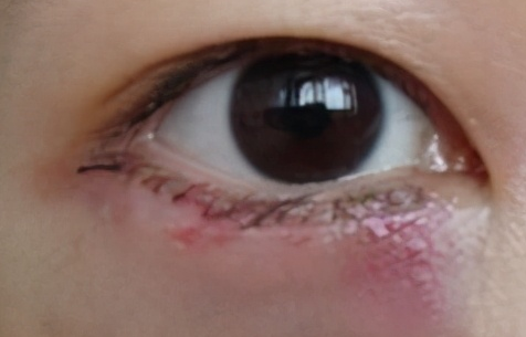 激光去眼袋會(huì)不會(huì)留疤？