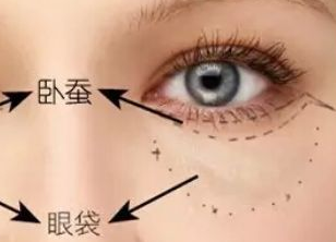 激光祛眼袋多久才能恢復(fù)？